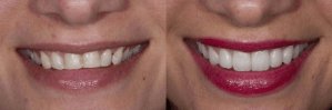 conditions that porcelain veneers can correct